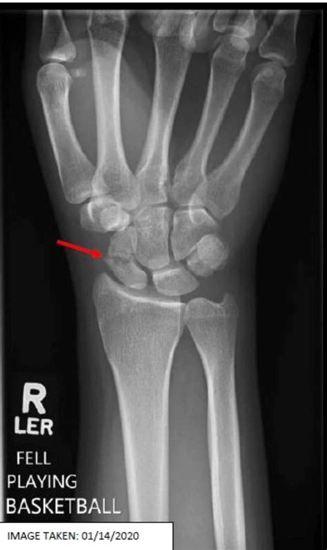 scaphoid fracture x ray